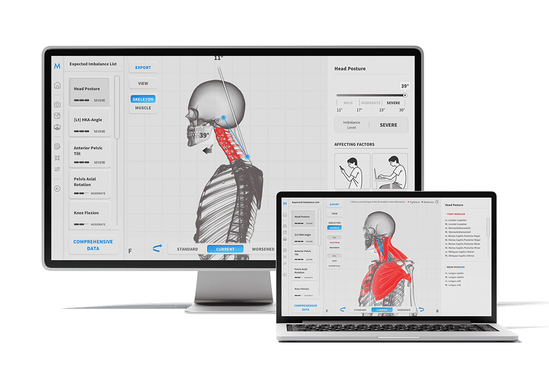 AI Posture Analysis for Patients in Chicago