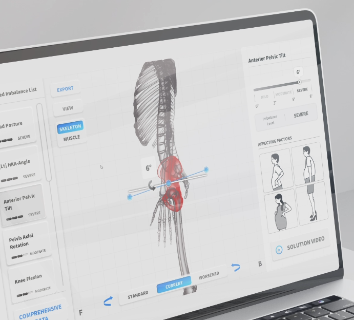 Moti Physio Posture Analysis