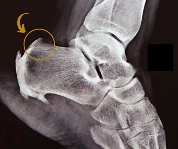 Shockwave therapy for Haglund's deformity in Gold Coast, Chicago
